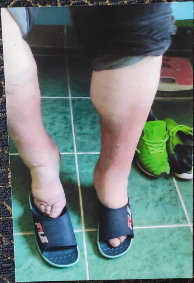 Hiperbarična komora tretman hiperbarična komora