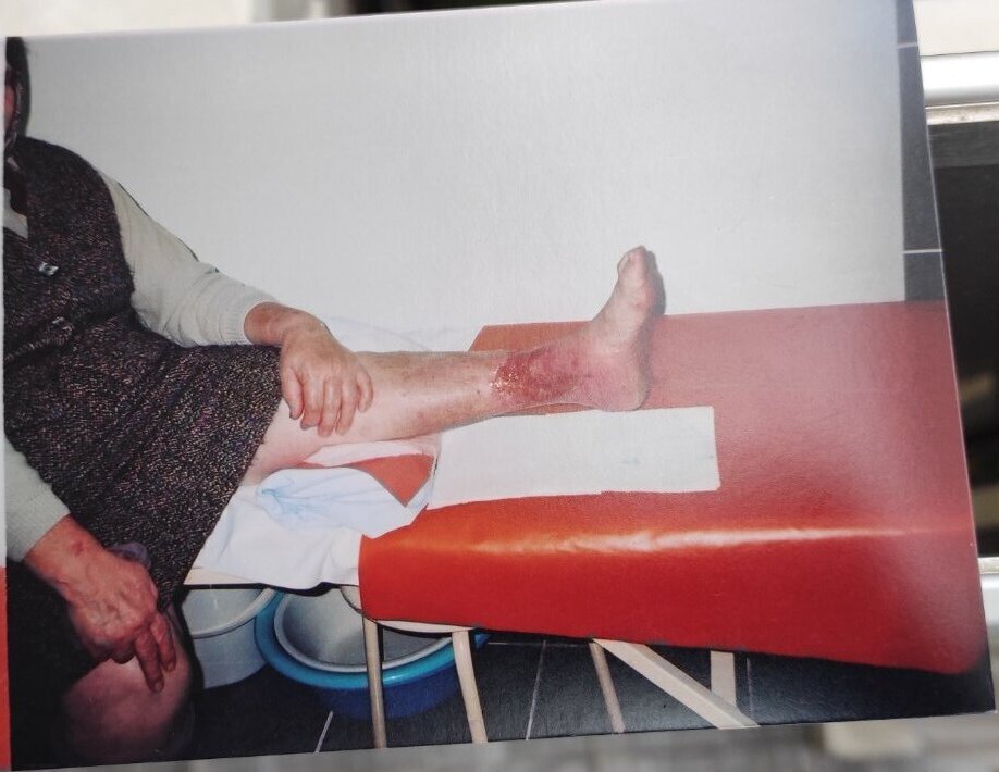 Hiperbarična komora tretman hiperbarična komora