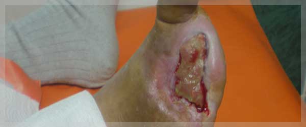 Izgled rane posle tretmana hiperbaricnom komorom