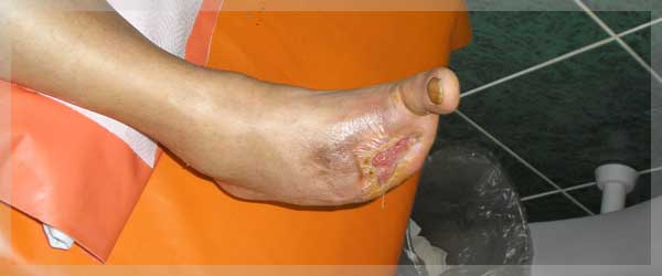 Izgled rane posle tretmana u hiperbaricnoj komori