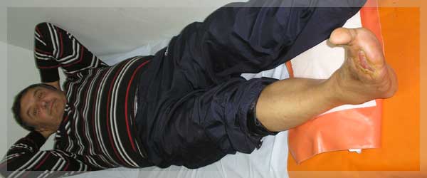 Izgled rane nakon hiperbaricne oksigenacije