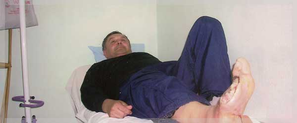 Izgled rane pre tretmana u hiperbaricnoj komori